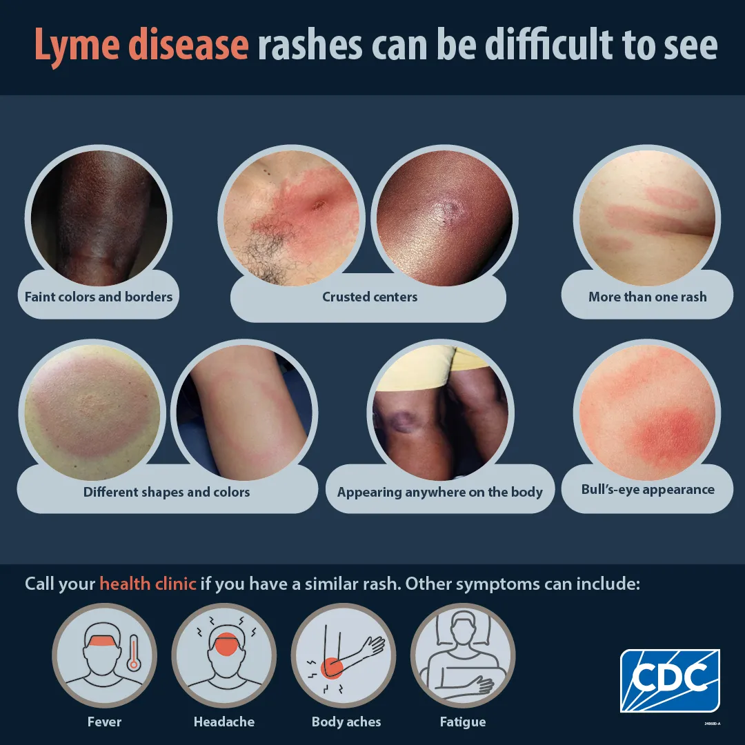 Lyme disease
