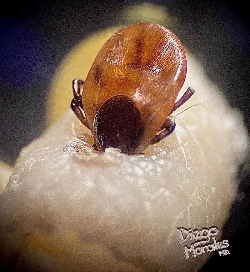 Burning a Tick Off Is Still the Go-To Advice in Half the Country — And It Makes the Situation Worse